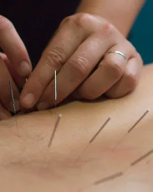 Western acupuncture and dry needling treatment